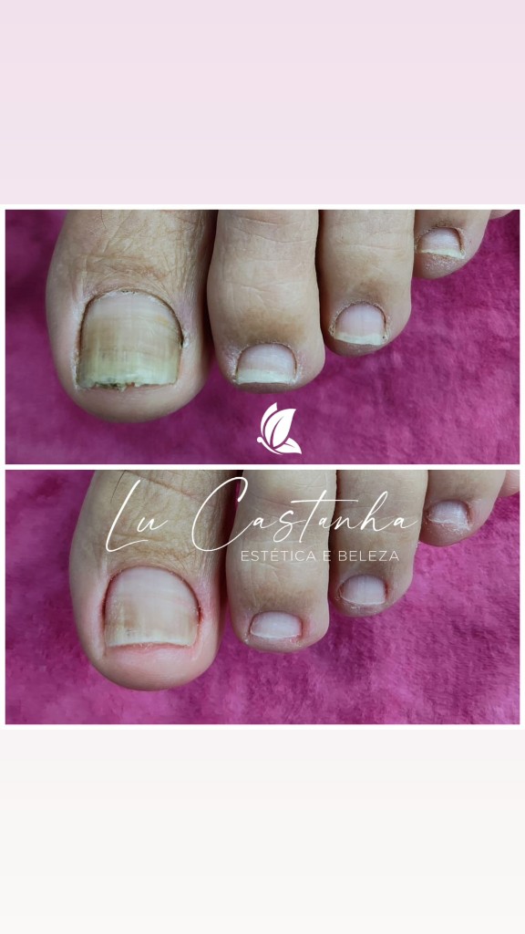 Pedicure