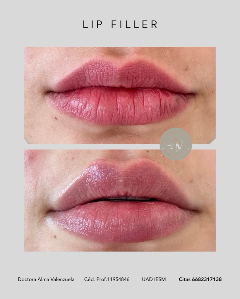 Armonización de labios