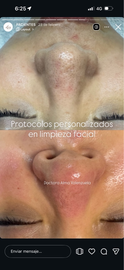 Limpieza facial con aquapeel