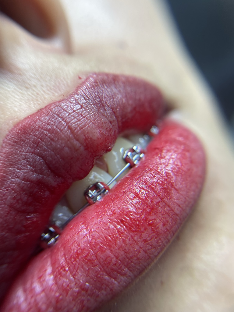 Microlips
