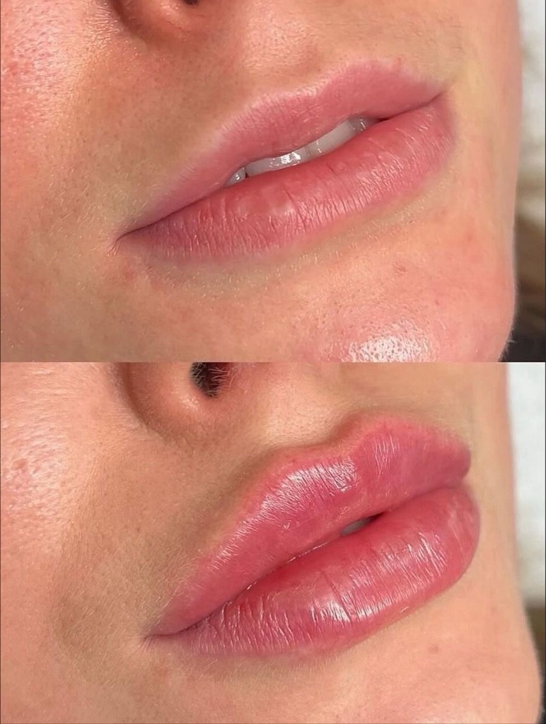 Aumento de labios - hyaluron pen