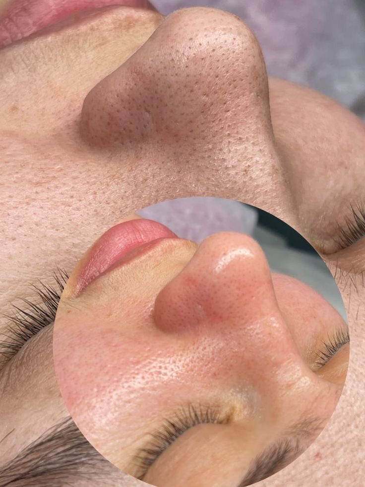 Limpieza facial profunda