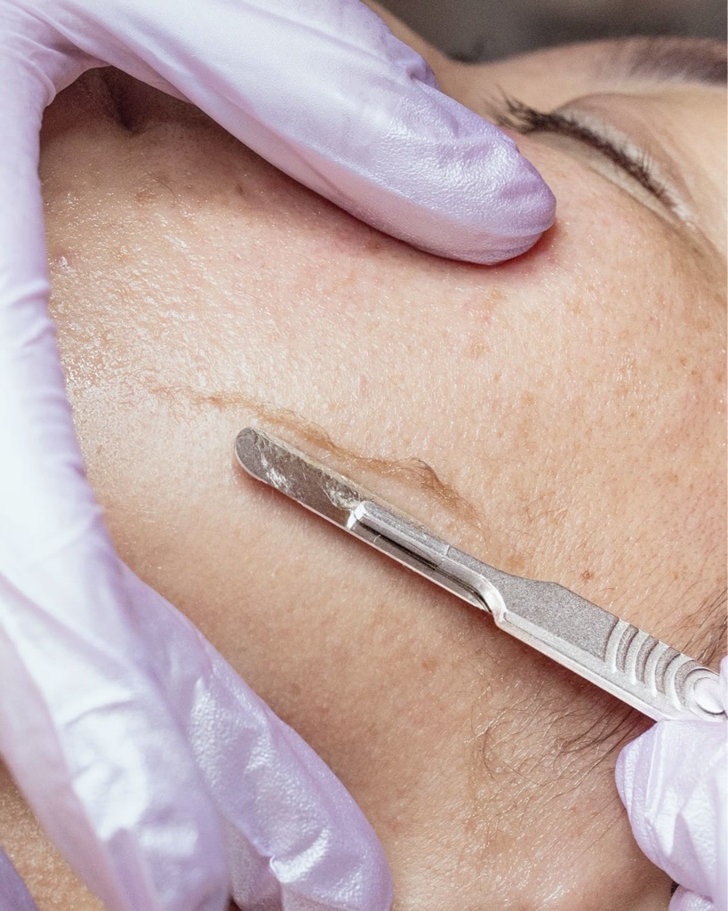 Dermaplaning