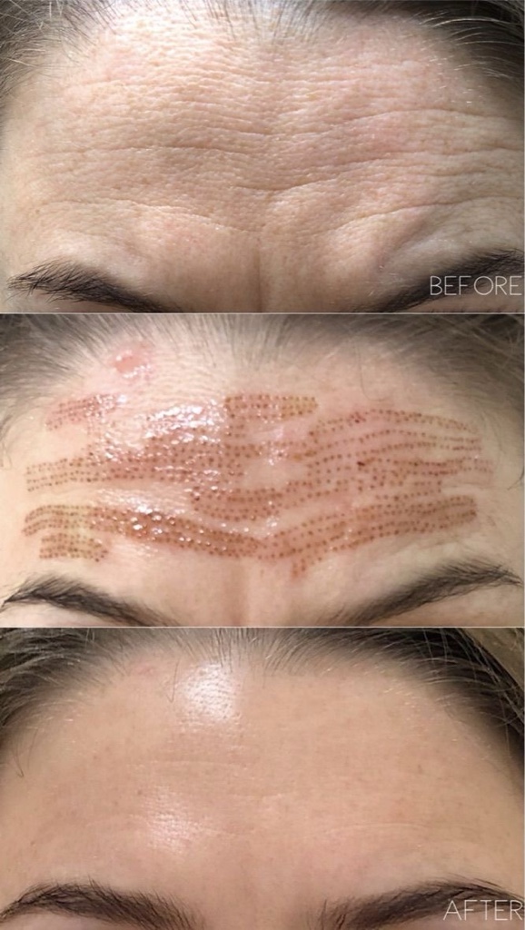 Plasmapen fibroblast