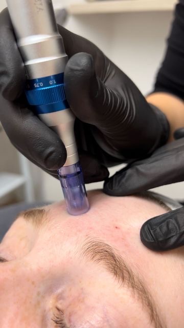 Microneedling (dermapen)