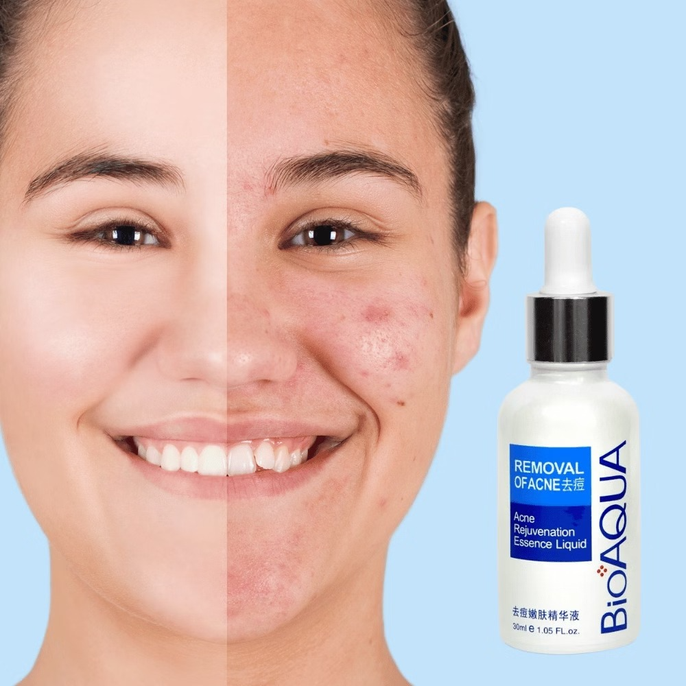 SERUM FACIAL ANTIACNE